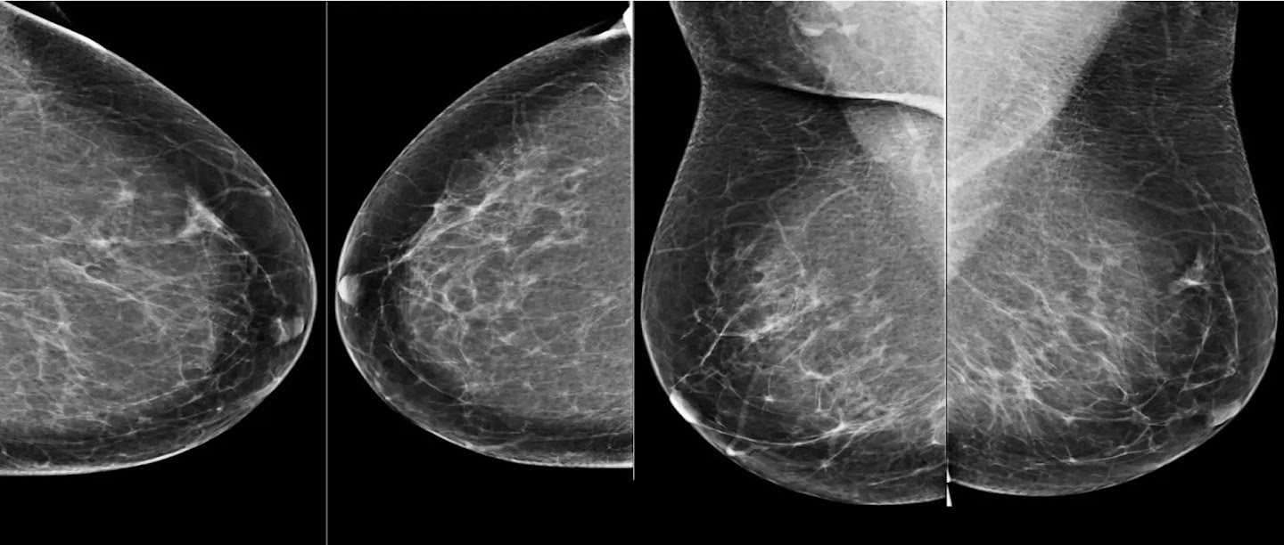 A mammogram showing four images – two of each breast from different angles.